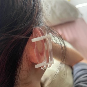 Disques en plastique pour compression chéloïde de l'oreille Boucle d'oreille en plastique pour pression chéloïde post-opératoire Forme haricot 3 tailles disponibles image 8