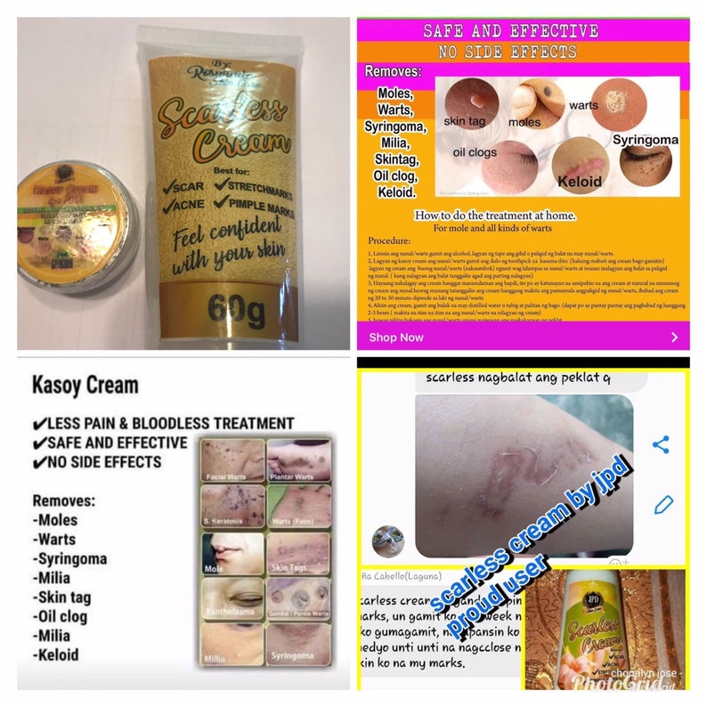2 in 1 Kasoy Cream Removes Warts Moles Skin Tag & More Etsy