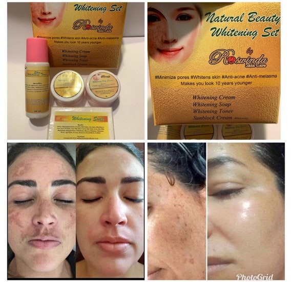 roswinda melasma soap