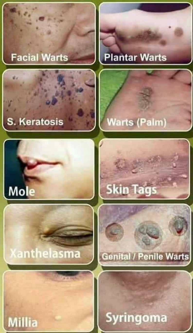 2 in 1 Kasoy Cream Removes Warts Moles Skin Tag & More Etsy