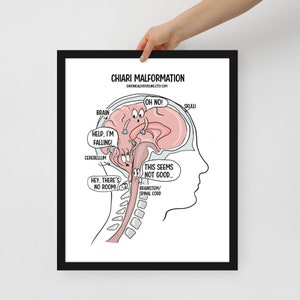 CHIARI MALFORMATIE medische cartoon grappige ingelijste poster