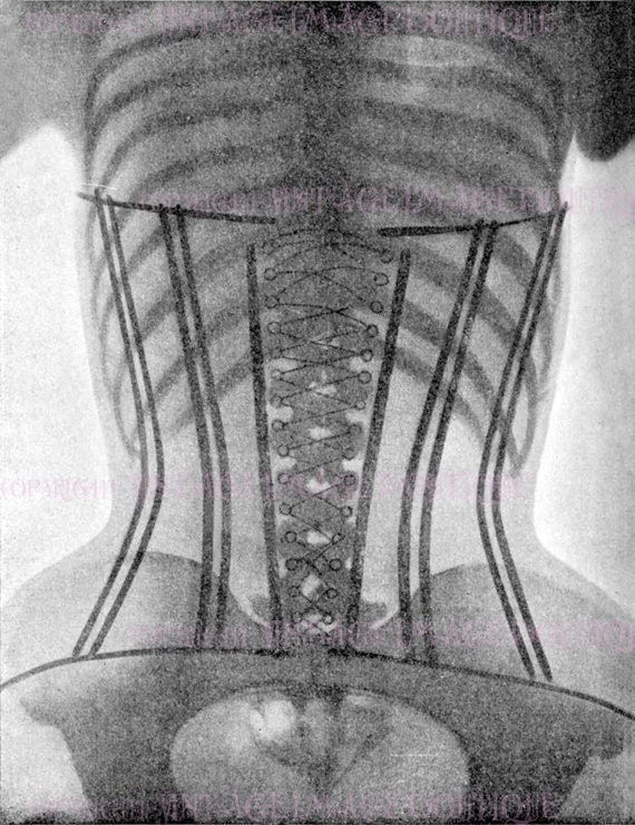 Antique Late Victorian X-Ray Of A Woman's Torso Altered By Wearing A  Whalebone Corset Medical Scientific 5x7 Greeting Card