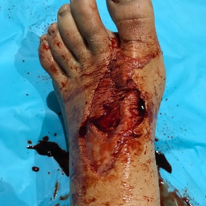 Entry & Exit Gun Shot Foot Wound: Two Piece Encapsulated Silicone Prosthetic image 1