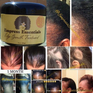 Hair Loss Treatment Hair growth Cream 2 Month Supply Balding Alopecia Thinning Edges Bald Spots For Men or Women Black Castor Oil