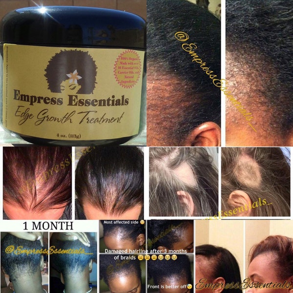 Haar-Verlust-Behandlung Haarwuchs-Creme 2-Monats-Versorgung Glatzenbildung Alopezie Ausdünnung Kanten kahle Stellen für Männer oder Frauen schwarz Rizinusöl