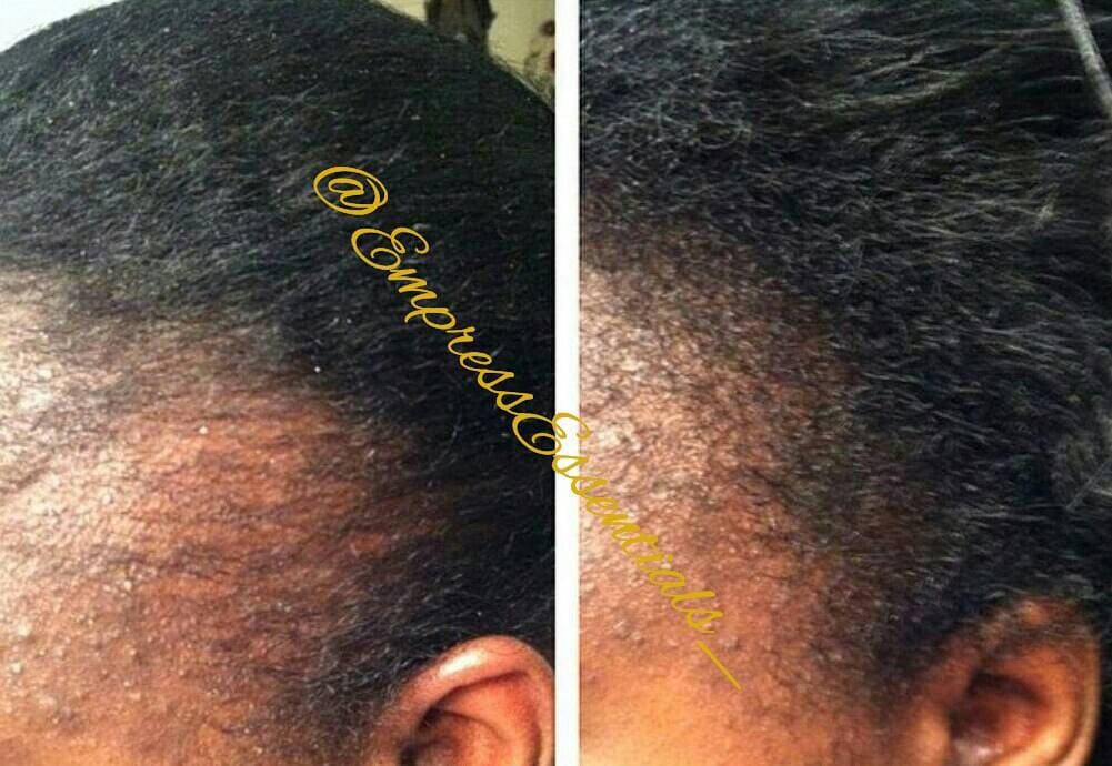 Hair Loss Hair Regrowth Cream Treatment 1 Month Supply Etsy