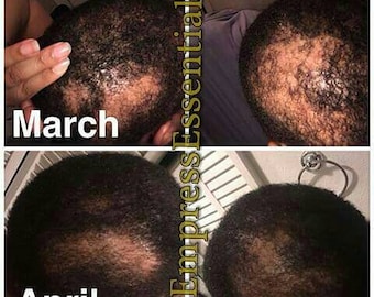 抜け毛治療 育毛クリーム 1ヶ月分 薄毛・脱毛症・薄毛対策 男性・女性用 ブラックキャスターオイル