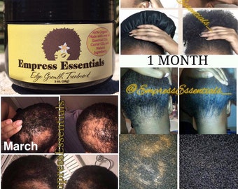 Hair Loss Treatment Hair growth Cream 1 Month Supply Balding Alopecia Thin Edges Bald Spots For Men or Women Black Castor Oil