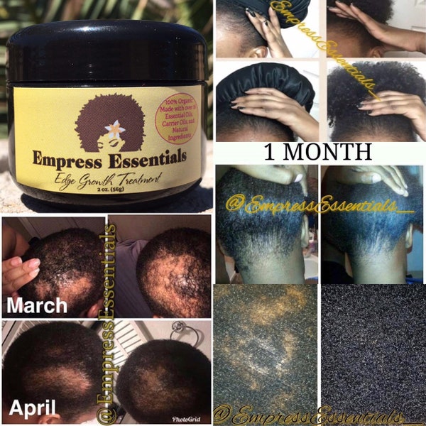 Behandeling van haaruitval Haargroeicrème 1 maandvoorraad Kalende Alopecia Dunne randen Kale plekken Voor mannen of vrouwen Zwarte ricinusolie