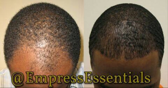 Hair Loss Treatment Hair Growth Cream 2 Month Supply Balding - Etsy