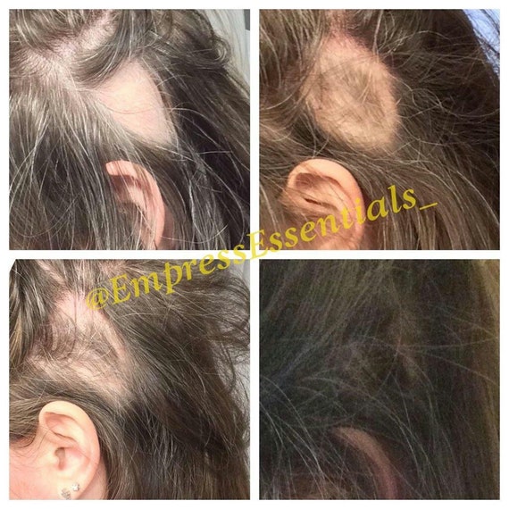 Hair Loss Treatment Hair Growth Cream 1 Month Supply Balding - Etsy