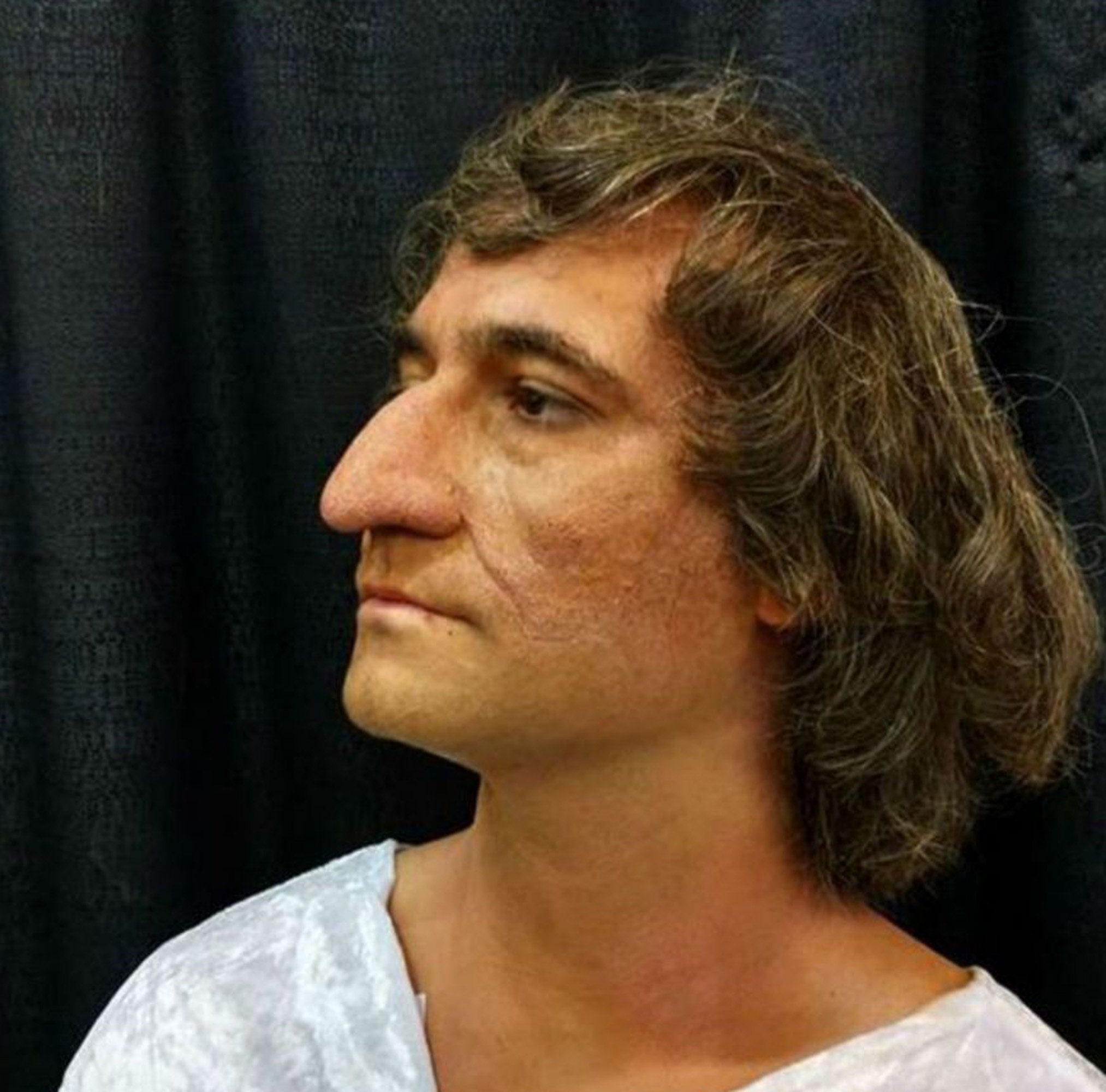 Prosthetic Nose -  Canada