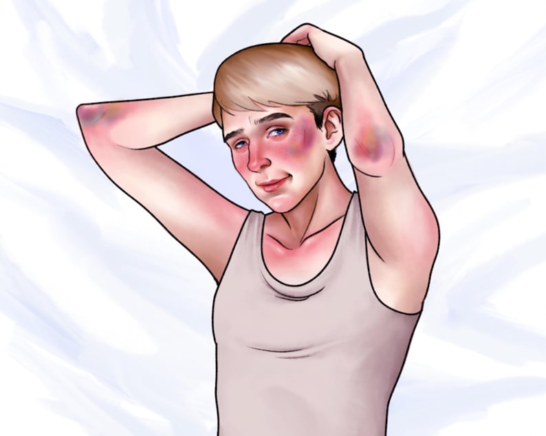 May include: A digital illustration of a person with short blonde hair wearing a light beige tank top. The figure has visible purple and blue bruising on the skin around the eyes and on the elbows, with flushed red cheeks and a neutral expression.
