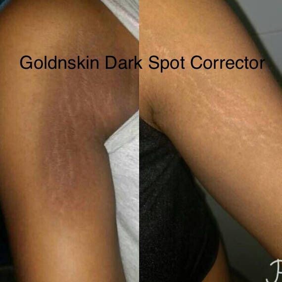 dark underarm lightening cream