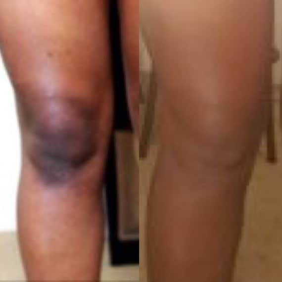 dark spot remover for arms