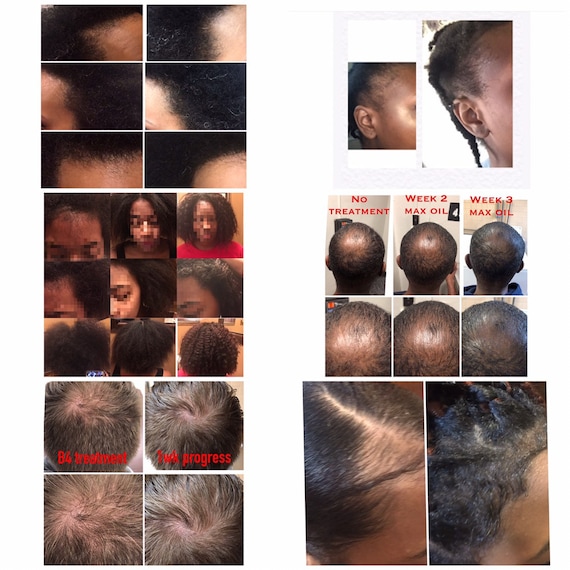 Hair Growth Oil Hair Strengthening Oil Max Oil Fast Etsy