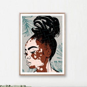 Vitiligo Print, Black Woman Wall Art, Beautiful Face with Vitiligo, Black Woman Braids, Woman Profile Printable, Instant Download, beauty