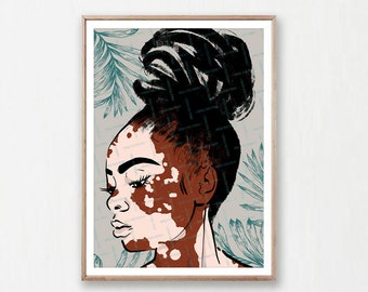 Vitiligo Print, Black Woman Wall Art, Beautiful Face with Vitiligo, Black Woman Braids, Woman Profile Printable, Instant Download, beauty