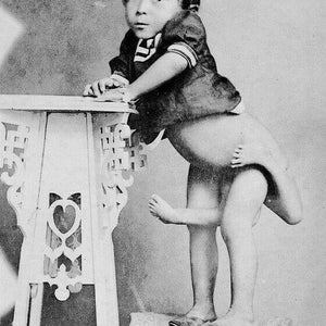 May include: A black and white photograph of a young child with a physical disability standing on a small table. The child is wearing a dark shirt and pants. The child's legs are fused together, and they are standing on the table with their feet together.