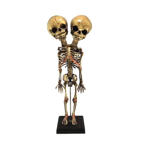 Deluxe Siamese Twin Conjoined Fetus Skeleton Two Headed Fetal Gaff
