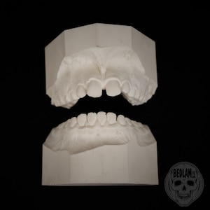 Childs Resin Dental Teeth Cast