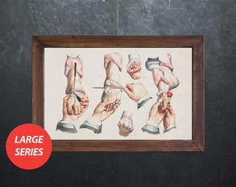 Anatomy art TOES AMPUTATION medical student gift, anatomical poster, decoration office doctor