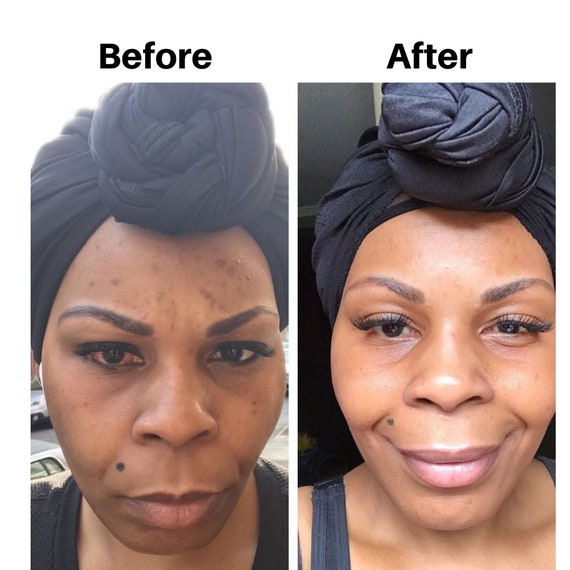 Turmeric and honey mask before and after