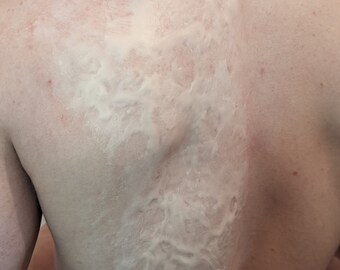 SILICONE BURN PROSTHETIC