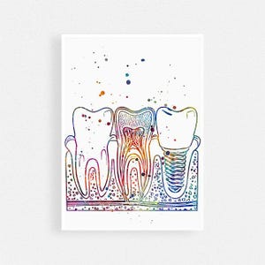 Dental implant art | Dentist office decor | Dental anatomy print | Dentist gift for women | Tooth implant | medical poster
