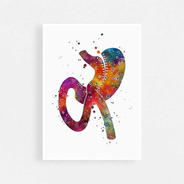 Mini Gastric Bypass surgery watercolor art print, Weight-loss surgery multicolored art poster, Doctor Surgeon Office wall decor, Unframed