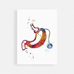 Gastric band, bariatric surgery, weight loss surgery watercolor art print