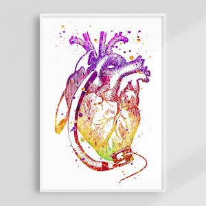LVAD Implant Surgery Art Print, Heart With Left Ventricular Assist Device, Medical Vibrant Artwork, Doctor Heart Surgeon Office Wall Decor