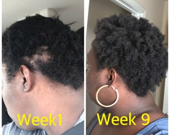 Natural Hair Growth Oil Serum for Fast Repair Hair Loss - Etsy Australia Natural Hair Growth Oil Serum for Fast Repair Hair Loss - Etsy Australia