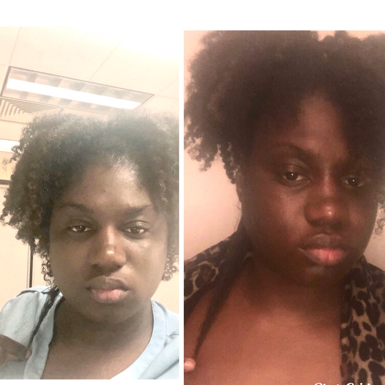 Before and after hair growth transformation