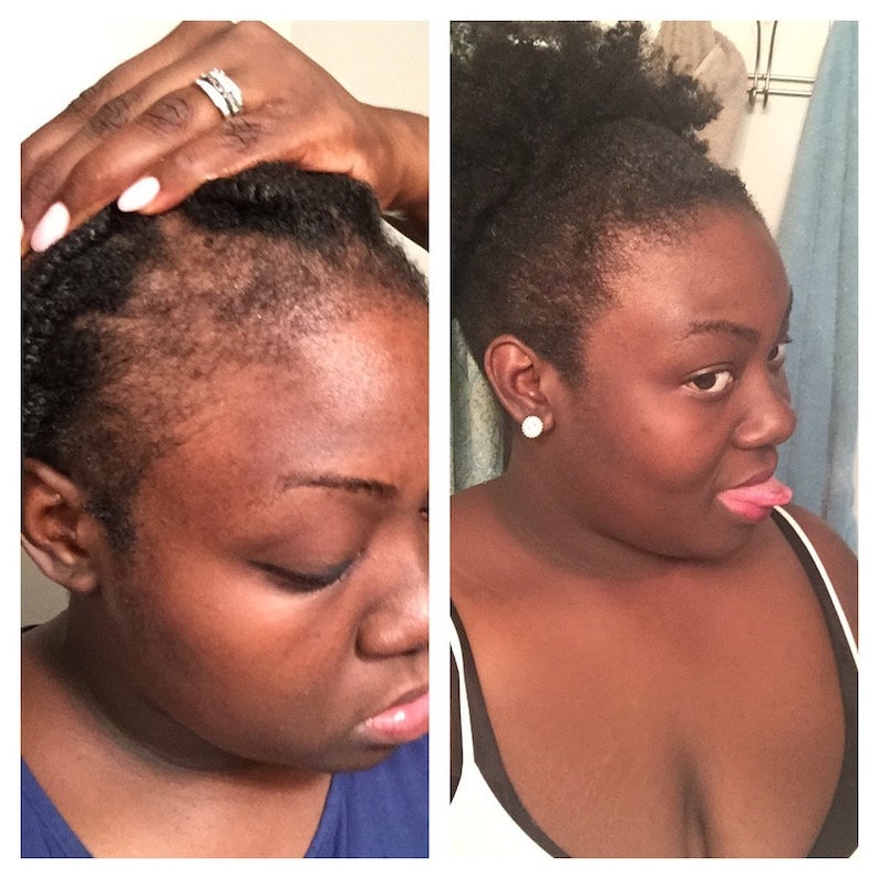 hair growth transformation