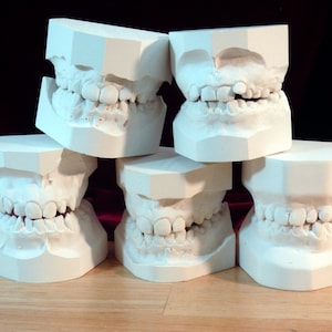 May include: Five white plaster dental molds of teeth, stacked on top of each other. The molds show the upper and lower teeth in a closed mouth position.