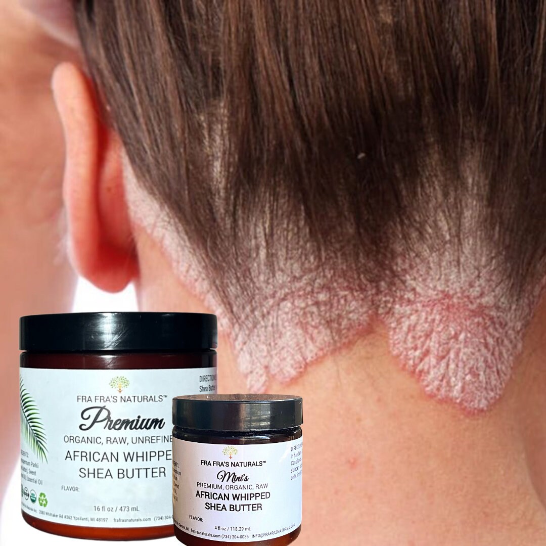 Fra Fra's Naturals EXTREME Healing Seborrheic Dermatitis Whipped Shea