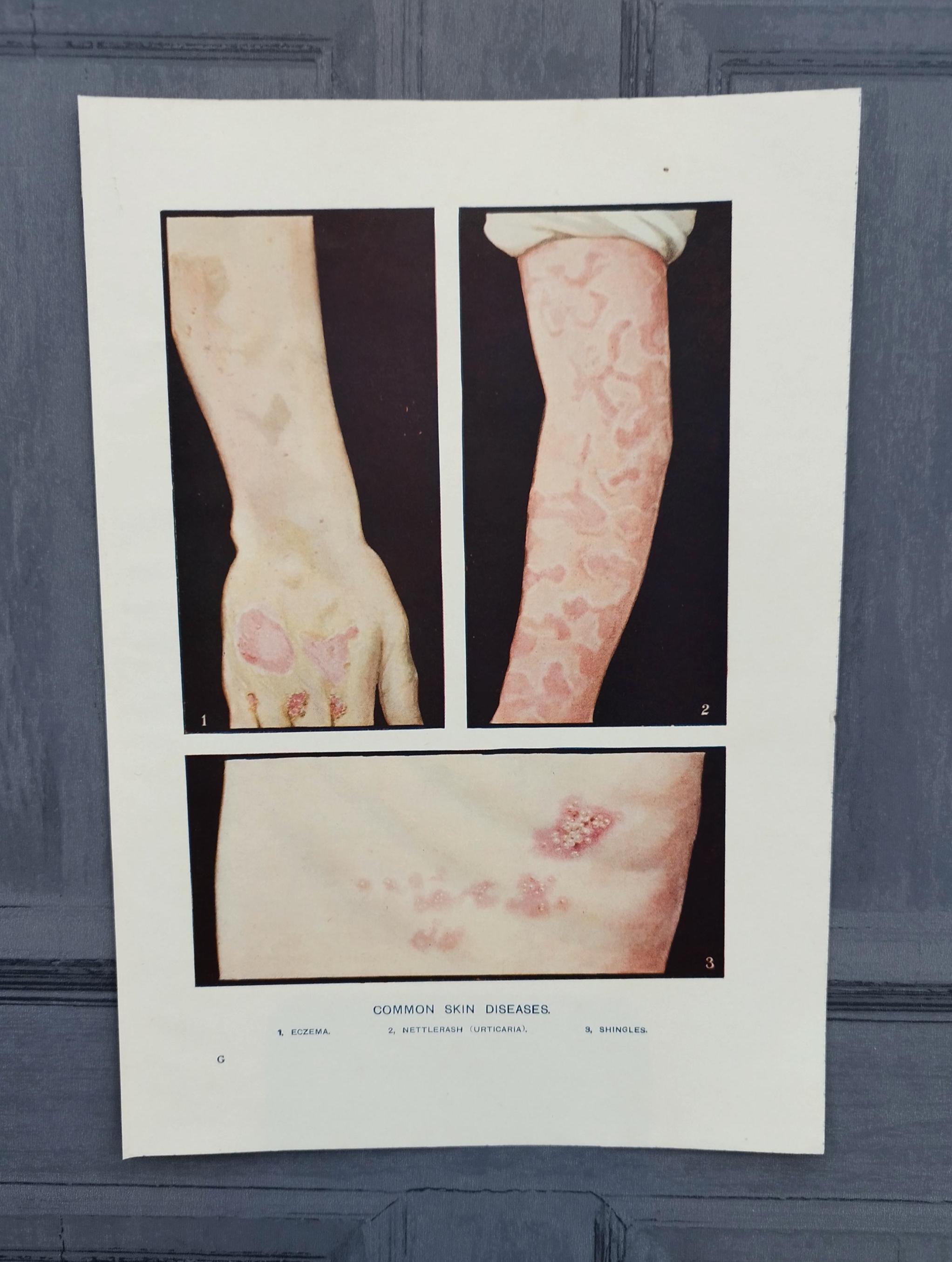 Book On Skin Rashes Pair of Genuine Antique 1912 Common Skin Diseases Book Print Art ...