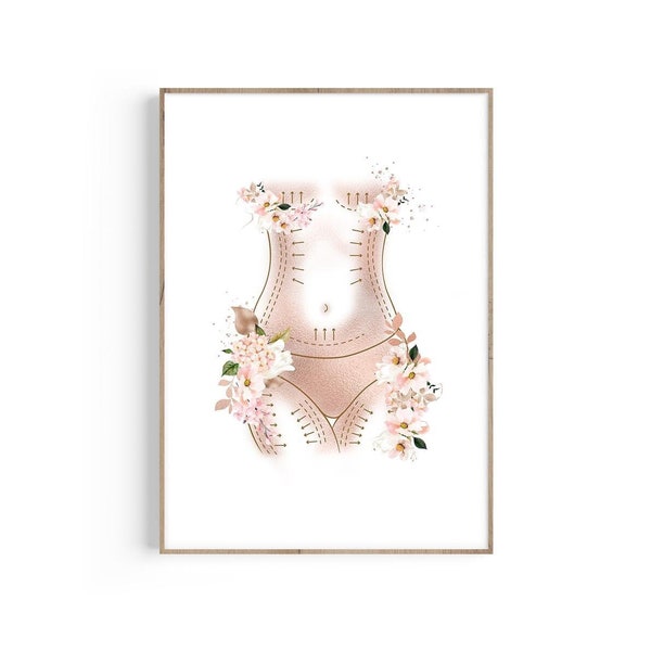 Mommy Makeover Print, Tummy Tuck Art, Abdominoplasty, Liposuction, Cosmetic Surgery Marking, Plastic Surgeon Gift, Butt Lift, Floral Anatomy