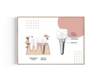 Tooth Anatomy Art Print: Dental Implant Diagram (Digital Download)