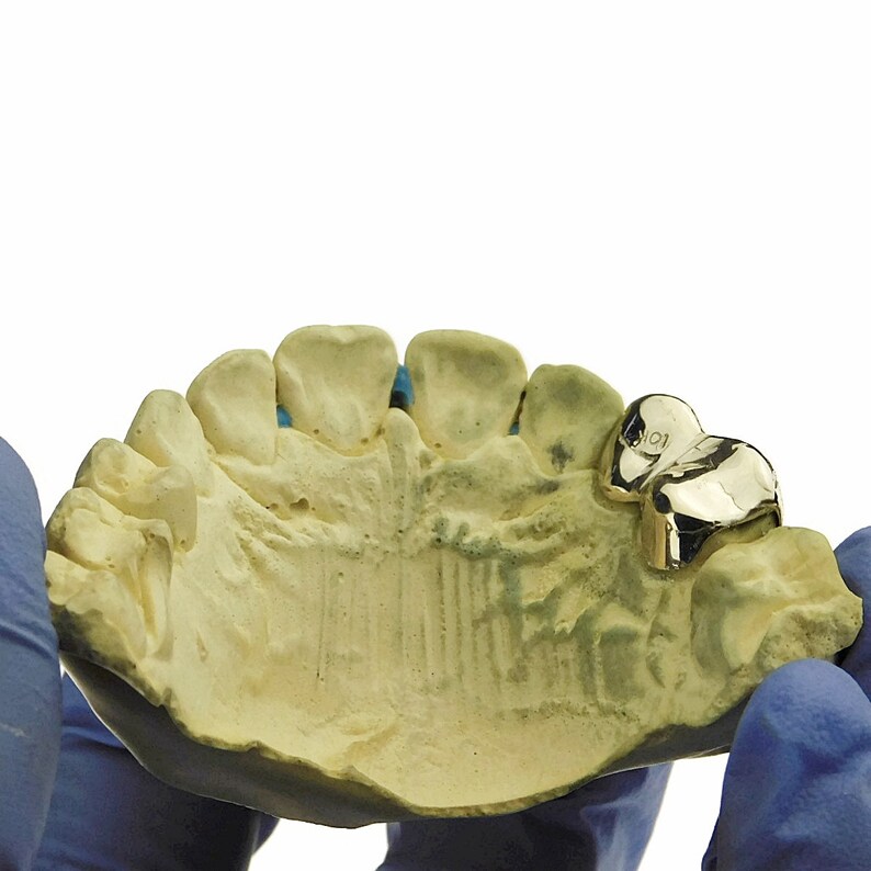 May include: A gold dental crown in a plaster mold. The crown is shaped like a tooth and has a small inscription on the side.