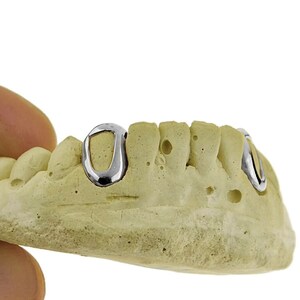 May include: A close-up of a dental model with two silver grillz, one on each side of the front teeth.