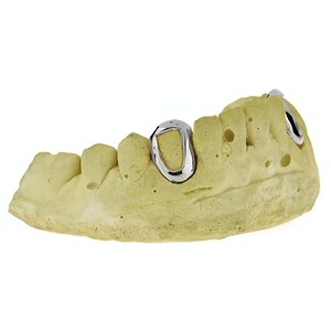 May include: A close-up of a dental model with two silver rings on the front teeth.
