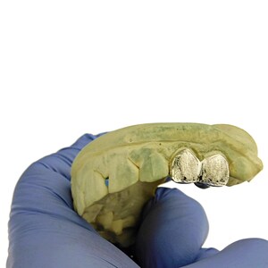 May include: A close-up of a dental mold with two silver-colored teeth. The mold is held in a blue latex glove.