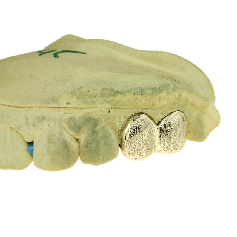 May include: Close-up of a dental mold with two gold teeth. The gold teeth are in the front of the mold and are slightly raised.