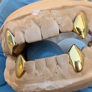 May include: Gold teeth grill with multiple gold teeth, set in a mold for fitting.