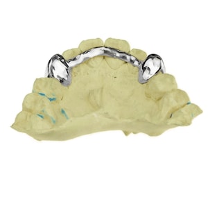 May include: A silver dental appliance with a curved bar and two prongs, mounted on a yellow plaster model of a mouth.