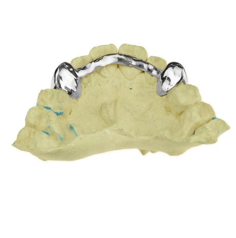 May include: A silver dental appliance with a curved bar and two prongs, mounted on a yellow plaster model of a mouth.