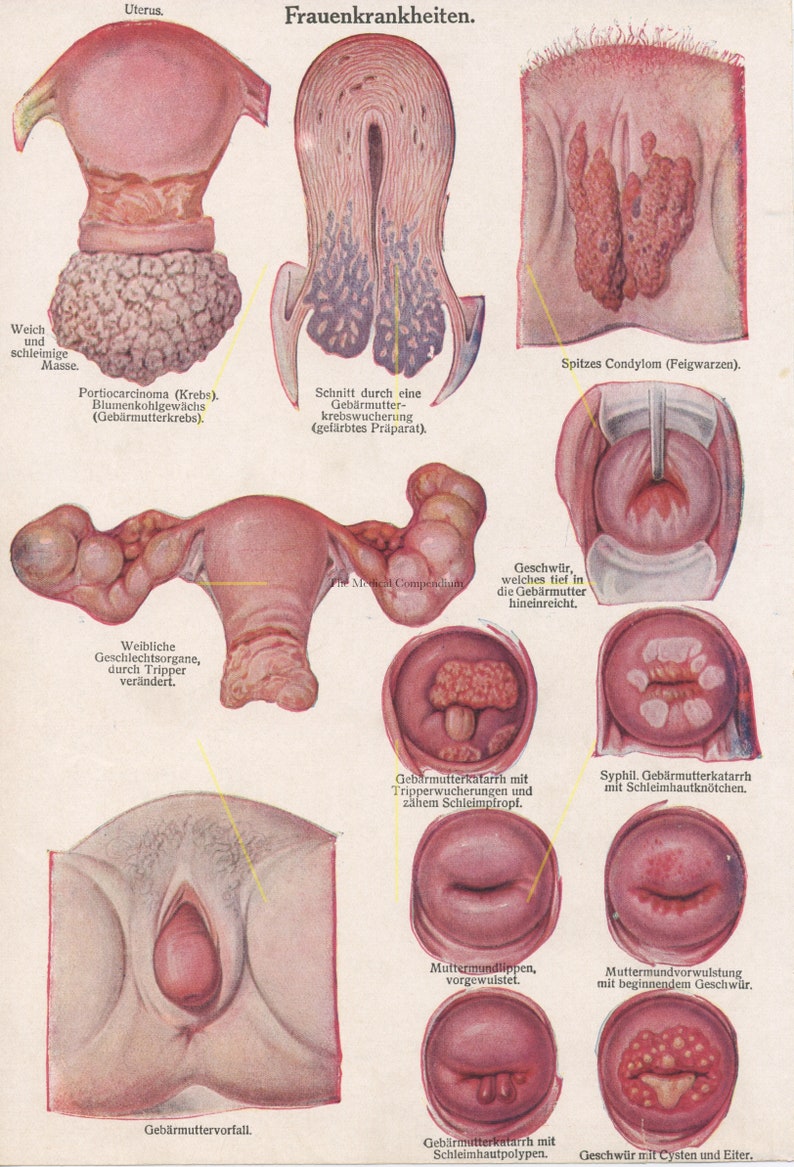 Vintage venereal disease print. Female reproductive system