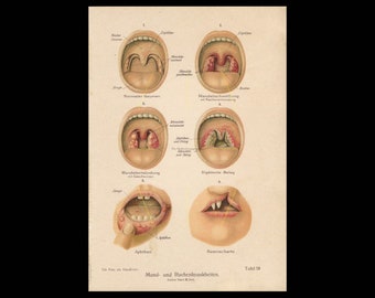 Antique mouth disease print. Diphtheria. Medical art. Tonsils. Cleft palate. Otolaryngology. Medical oddities. Medical student gift. 1905